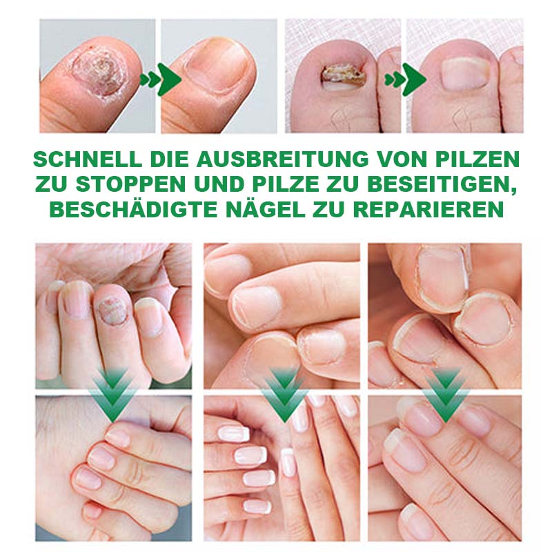 Nagelpflege Mit Ingwer