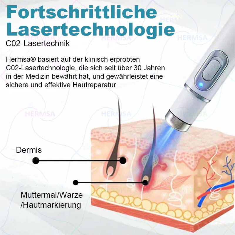 nicht-invasiver Laserpointer - Muttermal- und Warzenentfernung (🔥Letzter Tag 80% Rabatt)