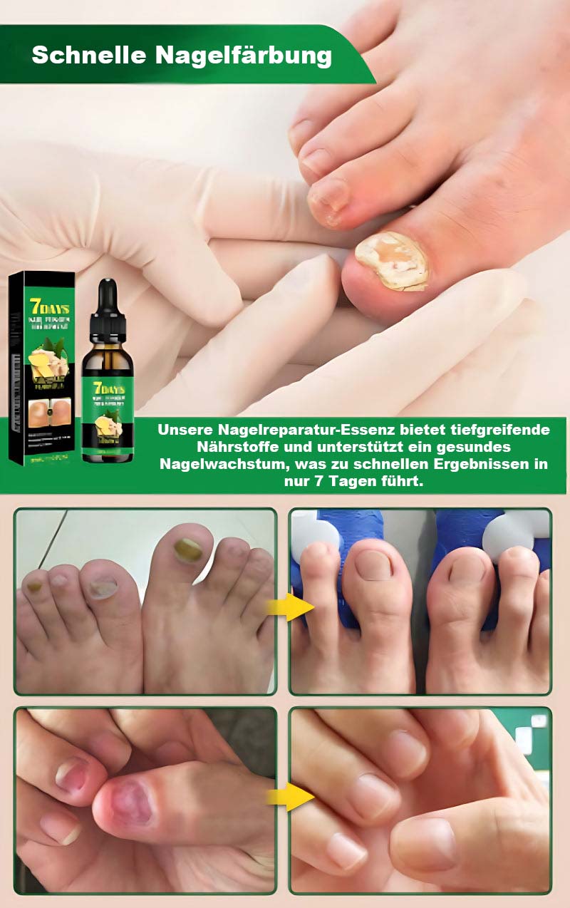 Nagelpflege Mit Ingwer