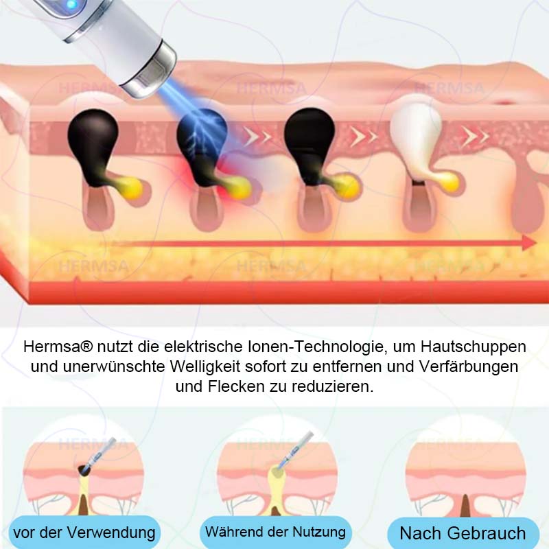 nicht-invasiver Laserpointer - Muttermal- und Warzenentfernung (🔥Letzter Tag 80% Rabatt)