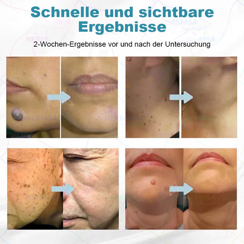nicht-invasiver Laserpointer - Muttermal- und Warzenentfernung (🔥Letzter Tag 80% Rabatt)