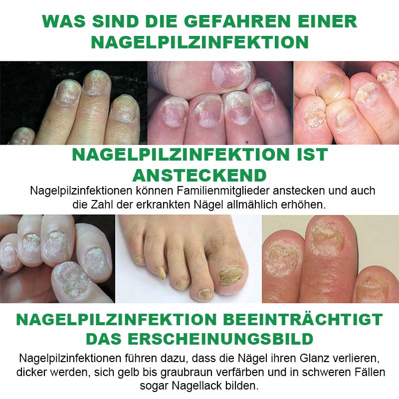 Nagelpflege Mit Ingwer
