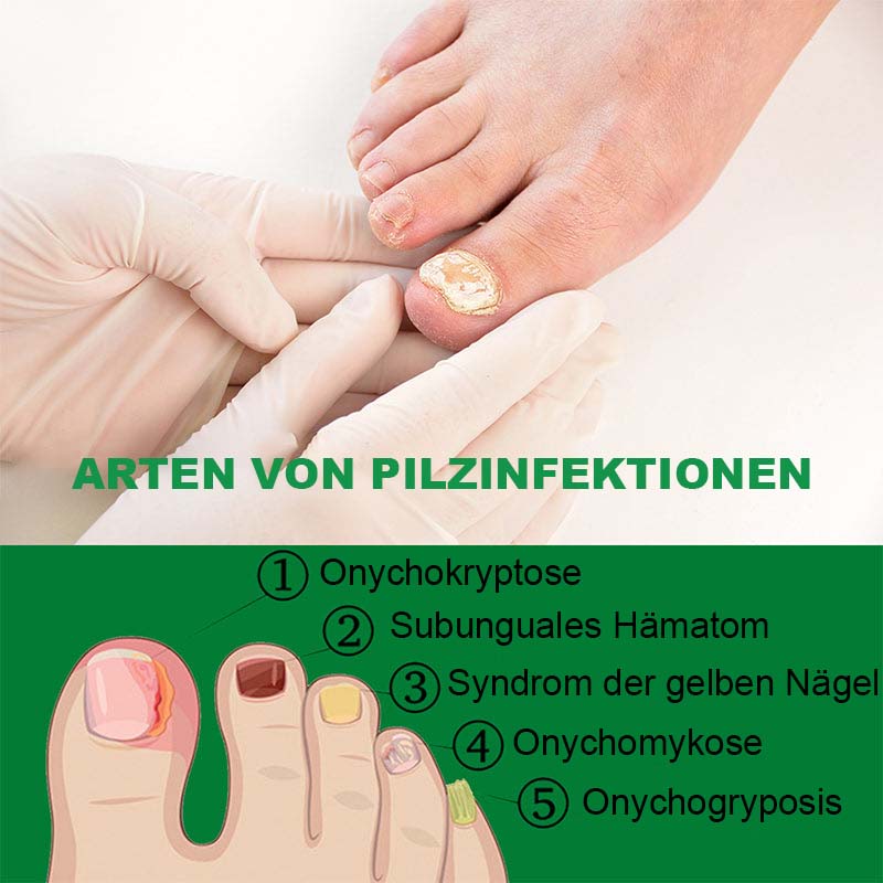 Nagelpflege Mit Ingwer